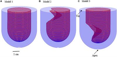 Numerical Simulation Study on the Mechanism of Formation of <mark class="highlighted">Apical Aneurysm</mark> in Hypertrophic Cardiomyopathy With Midventricular Obstruction